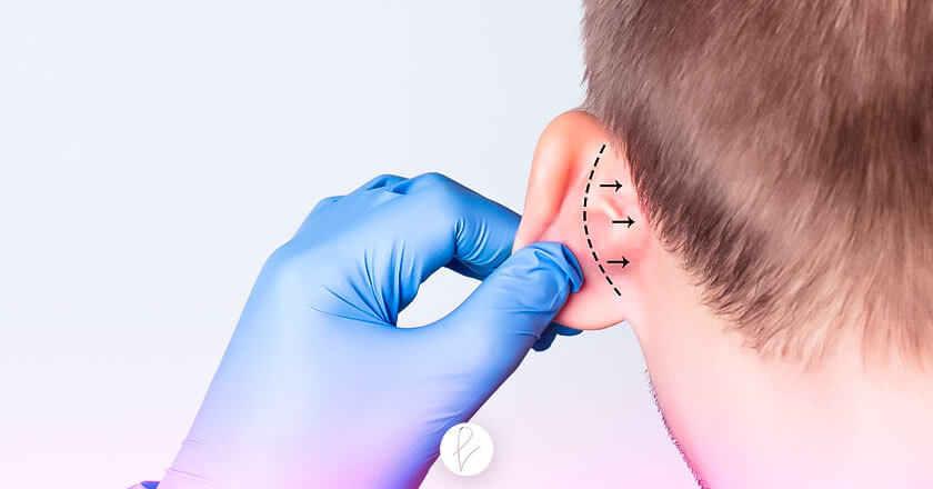 ¿En qué consiste la Otoplastia?